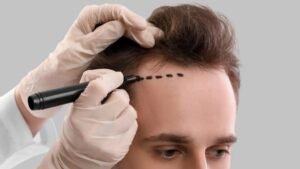 Read more about the article Achieve Natural-Looking Results with زراعة الشعر في دبي