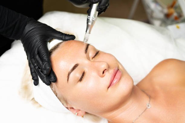 You are currently viewing How Effective Is Microneedling for Wrinkles?