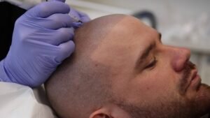 Read more about the article How Effective Is Scalp Micropigmentation Today?