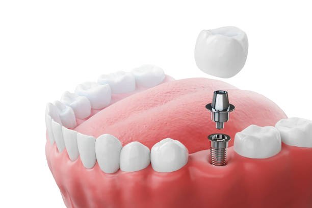 You are currently viewing How Long Do Dental Implants Typically Last?