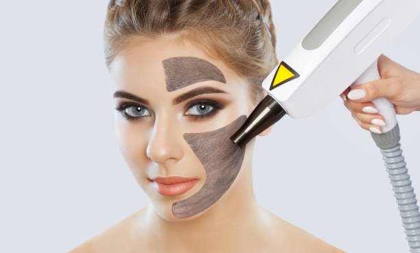 You are currently viewing How Long Do Results of Laser Carbon Peel Last?