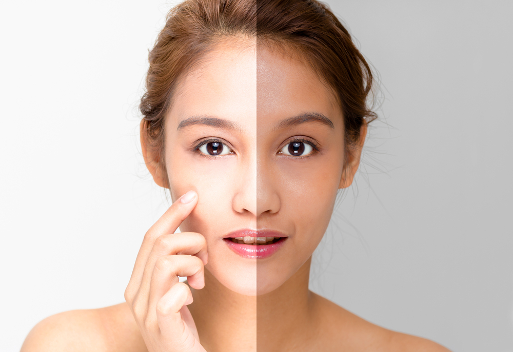 You are currently viewing How Long Do Skin Whitening Treatment Results Last?