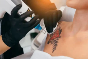 Read more about the article How Long Does Tattoo Removal Take