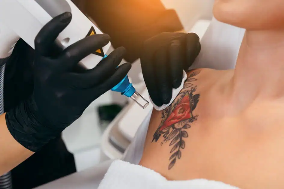 You are currently viewing How Long Does Tattoo Removal Take