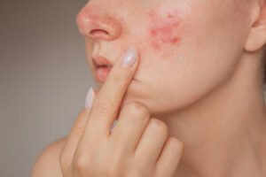 Read more about the article Is Acne Treatment Suitable for Severe Acne Cases?