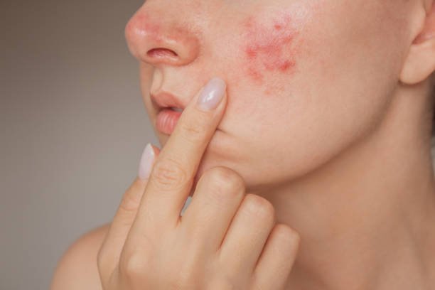 You are currently viewing Is Acne Treatment Suitable for Severe Acne Cases?