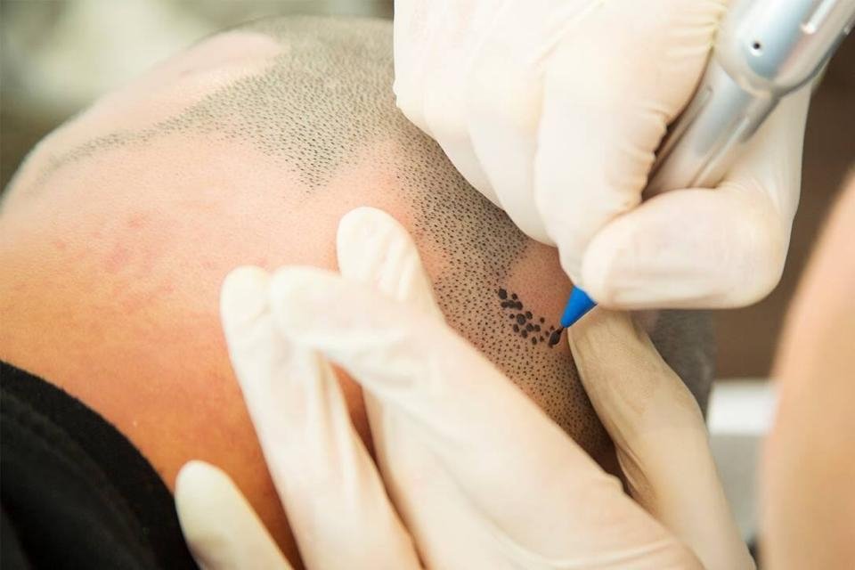 You are currently viewing Is Scalp Micropigmentation Painful or Mild?