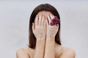 Read more about the article Is Vitiligo Treatment Suitable for Sensitive Skin?