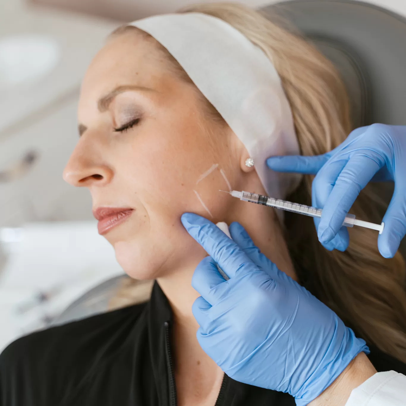 You are currently viewing Jawline Filler Treatments for a Stronger Profile