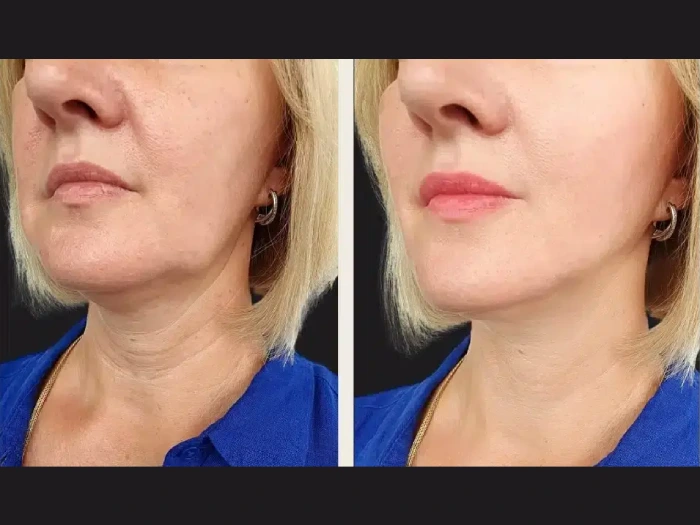 You are currently viewing Best Doctors in Dubai Advancing PRP Treatment Techniques