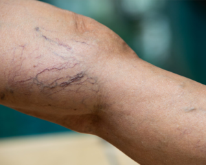 Read more about the article Personalized Spider Vein Treatment Plans