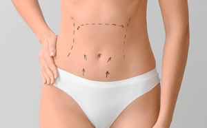 Read more about the article Reshape Your Midsection with Mini Abdominoplasty
