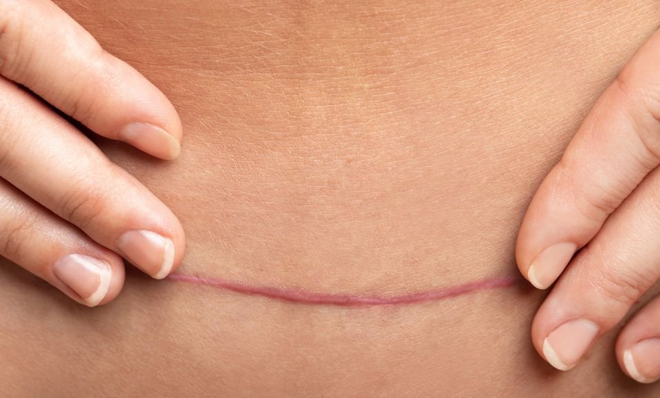 You are currently viewing Scar Removal for Children and Teens: What Parents Should Know