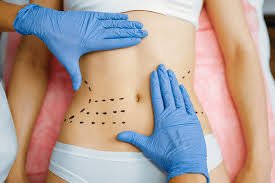 You are currently viewing Start Your Transformation with Tummy Tuck