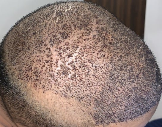 You are currently viewing Step into a New You with Hair Transplant