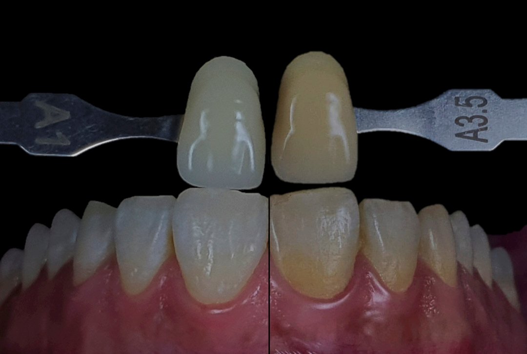 Read more about the article Dental Veneers in Diamond Bar for a Natural Smile Upgrade