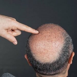 Read more about the article Why Hair Transplant Costs Vary So Much