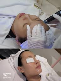 You are currently viewing Paradeplatz Hyaluron – Moderne Ästhetik im Herzen der Stadt