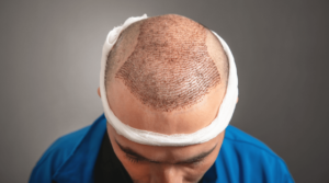 Read more about the article كيف أستعد لعملية زراعة الشعر؟