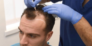 Read more about the article كيف تمنع زراعة الشعر بدون ندوب ظهور ندوب ظاهرة؟