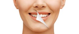 Read more about the article ما مدى سرعة ظهور نتائج تبييض الأسنان الاحترافي؟