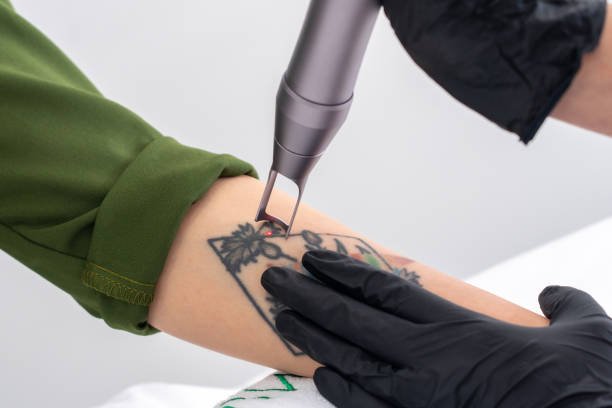 You are currently viewing Can Laser Tattoo Removal Remove Black Ink Fast?