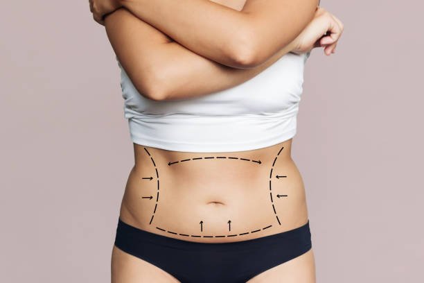 You are currently viewing Can Liposuction Improve Body Confidence Fast?