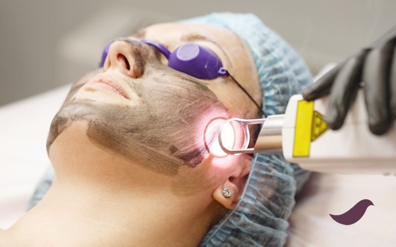 You are currently viewing How Long Do Laser Carbon Peel Results Last?