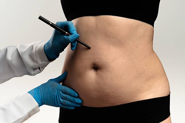 You are currently viewing How Skilled Should a Liposuction Surgery Doctor Be?