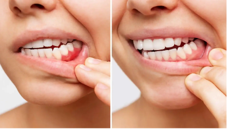 You are currently viewing Parodontologie Köln: Professionelle Hilfe bei Zahnfleischproblemen