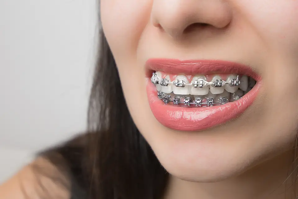 You are currently viewing Teeth Braces Cost Explained: What Patients Usually Pay
